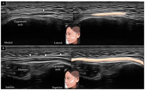 Ultrasound Imaging of the Facial Muscles and Relevance with Botulinum ...