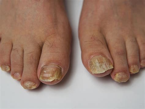 Hair on Toe Sign : पायाच्या बोटांवर केस नसणे म्हणजे गंभीर आजाराचा धोका ...