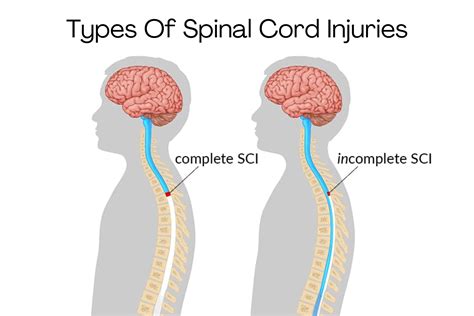 Spinal Cord Injuries Types - Complete Vs. Incomplete