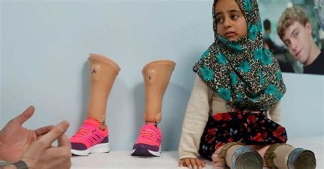 Syrian War Victim Who Used Tin Cans To Walk, Will Now Walk On ...