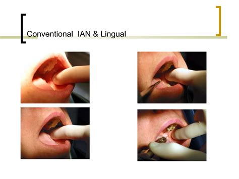 Local Anesthesia 的图像结果