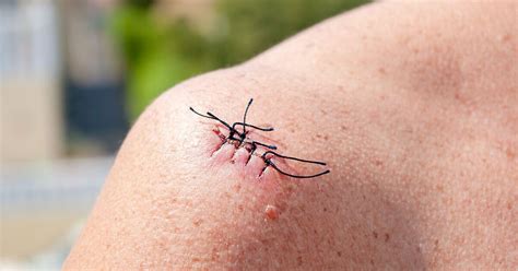 Removing Sutures Step by Step 的图像结果