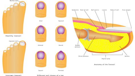 Ingrown Toenail Home Treatment Ingrown Toenail | NHS Inform