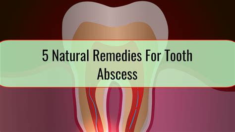 5 Natural Remedies For Tooth Abscess • Health blog