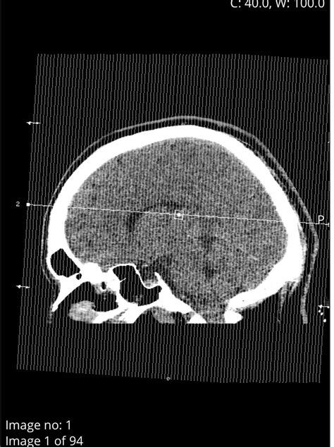 Incidental finding - Arachnoid cyst in brain : r/Radiology