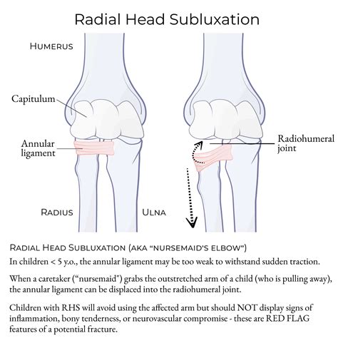 Subluxation Of Elbow Treatment