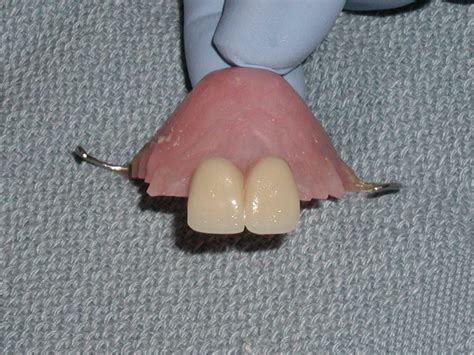 Flipper Tooth Replacement
