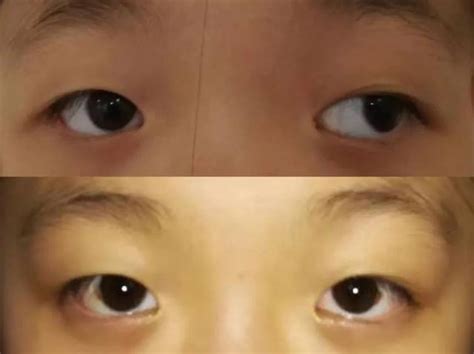 合肥爱尔眼科：孩子斜视愈发明显 患儿手术后恢复佳_好医生网