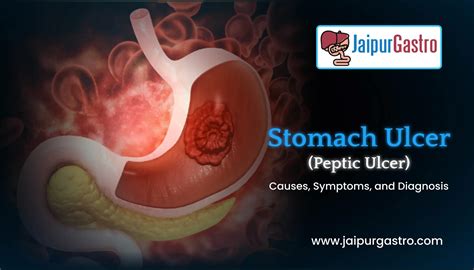 Stomach Ulcer (Peptic ulcer)