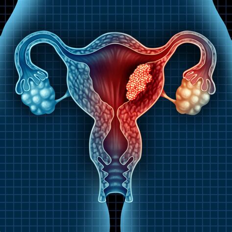 Uterine and Endometrial Cancer | Saint John’s Cancer Institute - Santa Monica, CA