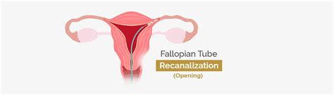 Image result for Fallopian Tube Replacement Surgery