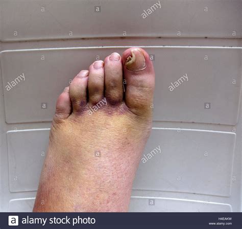Broken ankle, bruises and swelling on foot and toes after cast Stock ...