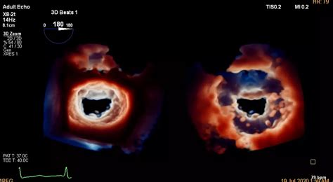EPIQ CVx Cardiac Ultrasound