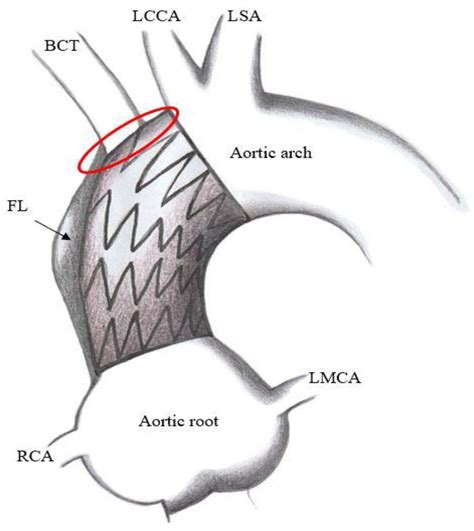 Endovascular Intervention for Aortic Dissection Is “Ascending”