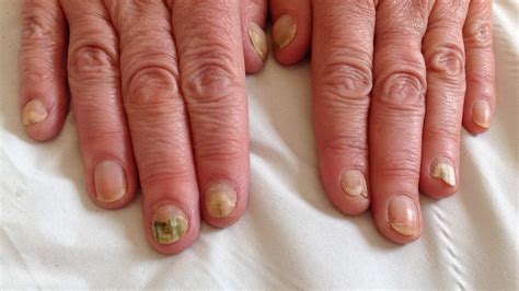 Finger Nail Infections – Are they fungal, candida or bacterial ...