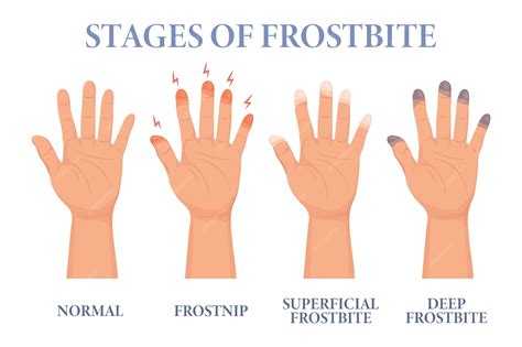 Premium Vector | Frostbite stages. frozen hands in different stages. medical frostbite. skin ...