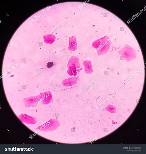 Gram Negative Diplococci In Sputum