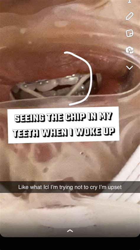 Jaw surgery ruined my face (before/after) : r/jawsurgery