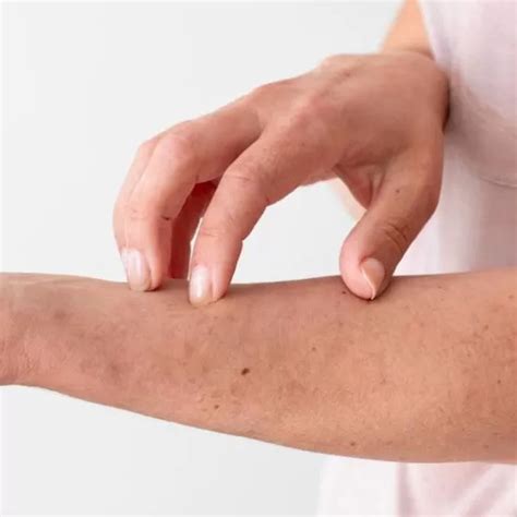 Diagnosing and Treating Varicose Eczema in Jaipur Today - Signature Skin