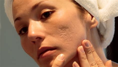 3 DIY Face Packs To Treat Acne Scars - lifeberrys.com