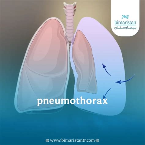 Pneumothorax