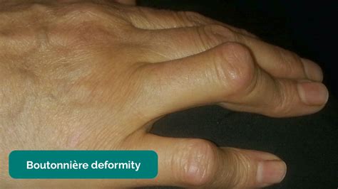 Image result for Hand Dysfunction