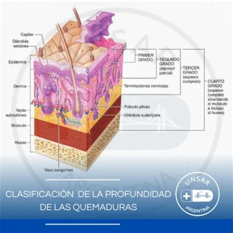 Diagrama De Quemadura De Tercer Grado HOSPITAL DEL NIÑO DOCTOR JOSÉ