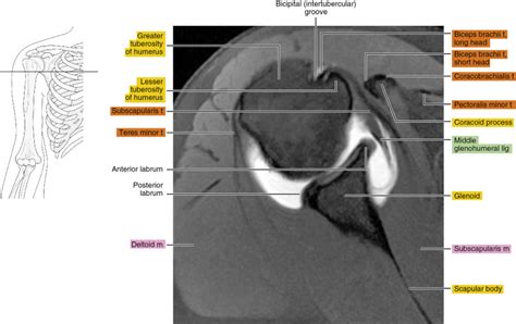 Mr Arthrogram Shoulder 的图像结果