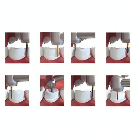 Buy Coltene Crown Preparation Kit IN60013857 – Oralkart
