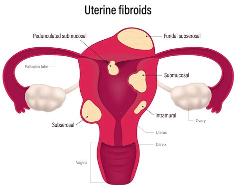 Understanding Fibroids: Types & Symptoms | Atlanta Fibroid Clinic