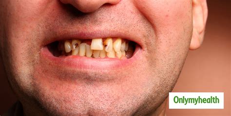 Testicular Cancer Symptoms and Signs In Hindi | Men's Health ...