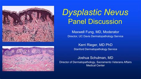 1 dysplastic_nevi_panel_discussion_-_fung_schulman_rieger.pdf