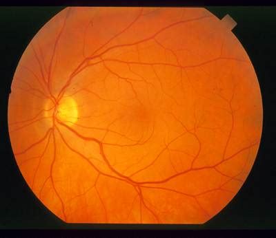 STARE - Dataset Ninja