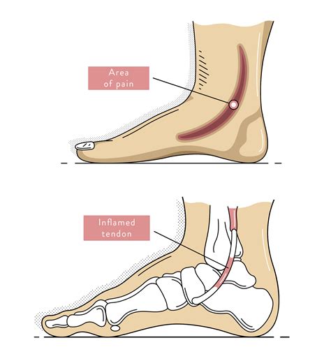 Heel Pain: Causes, Treatment & Prevention | Podiatry Sydney
