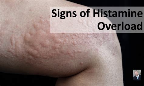 Histamine Reaction On Skin