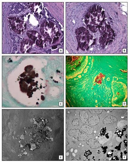 IJMS | Special Issue : Calcification in Human Pathology