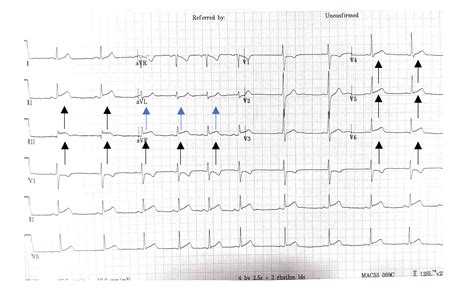 Pericardial Effusion Ecg