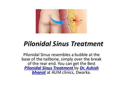 Pilonidal Sinus Treatment Dr Ashish Bhanot 9210000084 - Delhi - Click.in