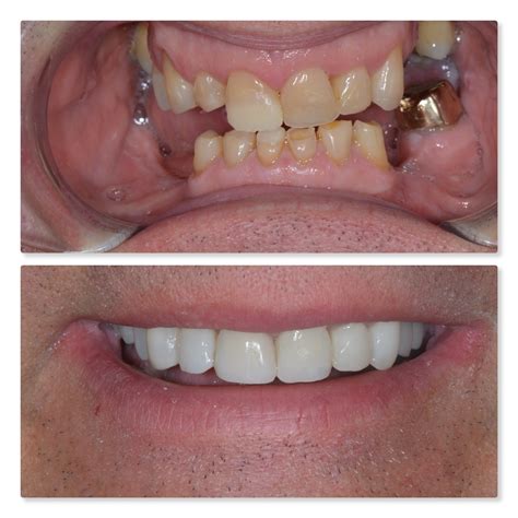 Dental Implants Before _ Dental implants before and after photos: How do they look? – RUAUE