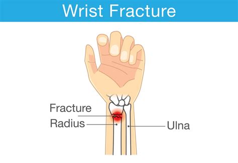 Image result for Distal Radius Fracture Recovery