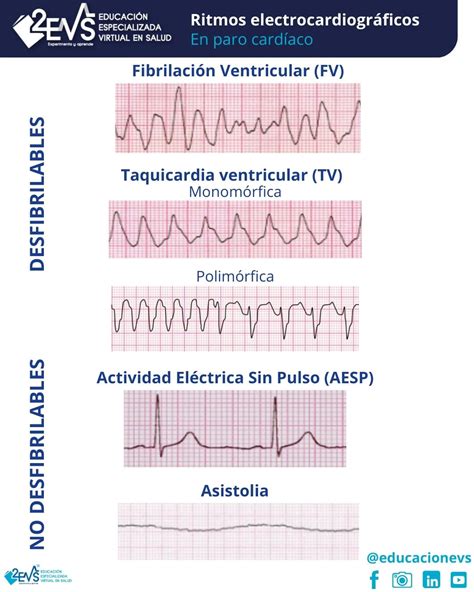 Taquicardia ventricular sin pulso: causas y tratamiento | Guía de salud ...