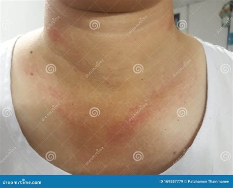 Red Marks On The Neck