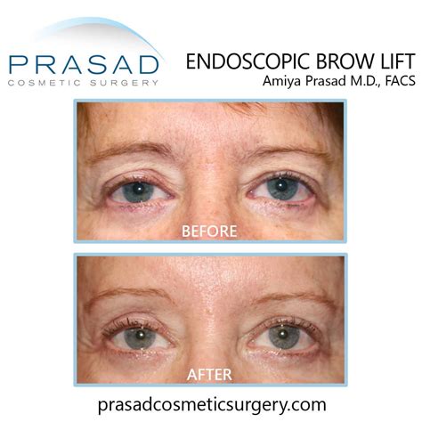 Brow Lift Before and After Photos | Manhattan and Long Island NY