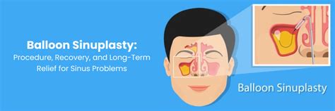 Balloon Sinuplasty: Procedure & Long-Term Sinus Relief