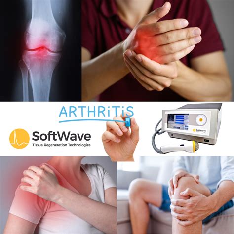 Can SoftWave Therapy Really Help Osteoarthritis? How Does It Provide Lasting Arthritis Pain ...