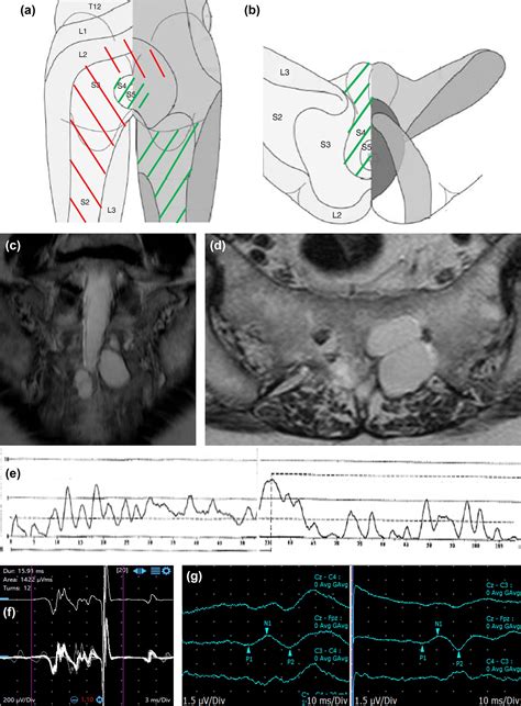 Sacral Tarlov cysts: Neurophysiology abnormalities and correlation with pelvic sensory and ...