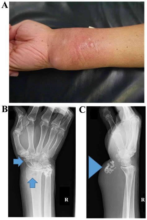 Screening of Soft Tissue Sarcoma