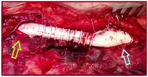 Simultaneous Endovascular Abdominal Aortic Aneurysm Repair and Open Repair of Common Femoral ...