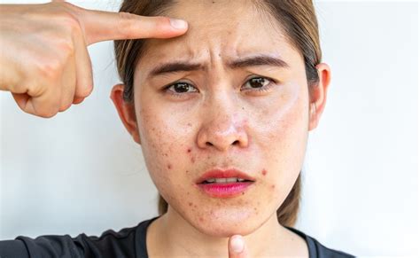 चेहरे पर दिखता है तेल और चिपचिपाहट, तो घर पर यूं बनाएं ऑयली स्किन का ...