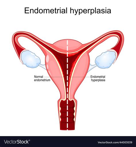 Image result for Hyperplastic Endometrium